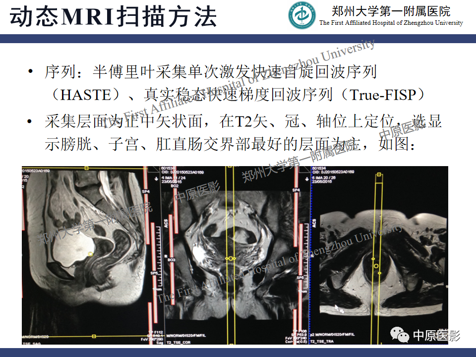 影像PPT - 【病例】盆底功能障碍性疾病2例MR影像-11