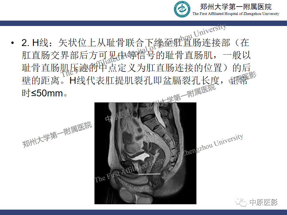影像PPT - 【病例】盆底功能障碍性疾病2例MR影像-16