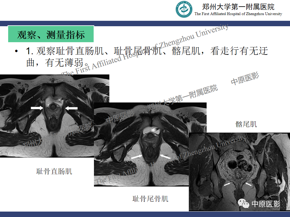 影像PPT - 【病例】盆底功能障碍性疾病2例MR影像-18
