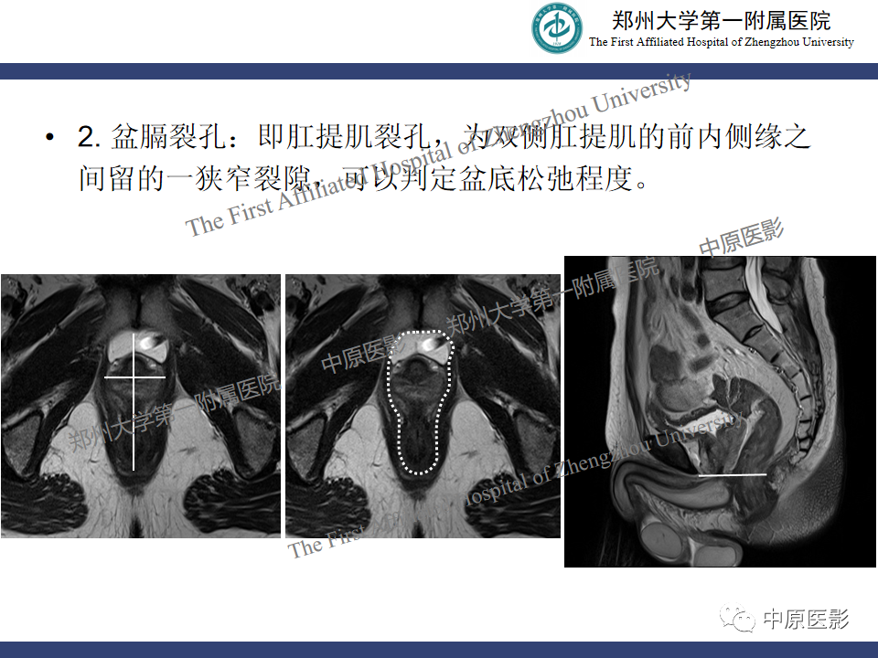影像PPT - 【病例】盆底功能障碍性疾病2例MR影像-19