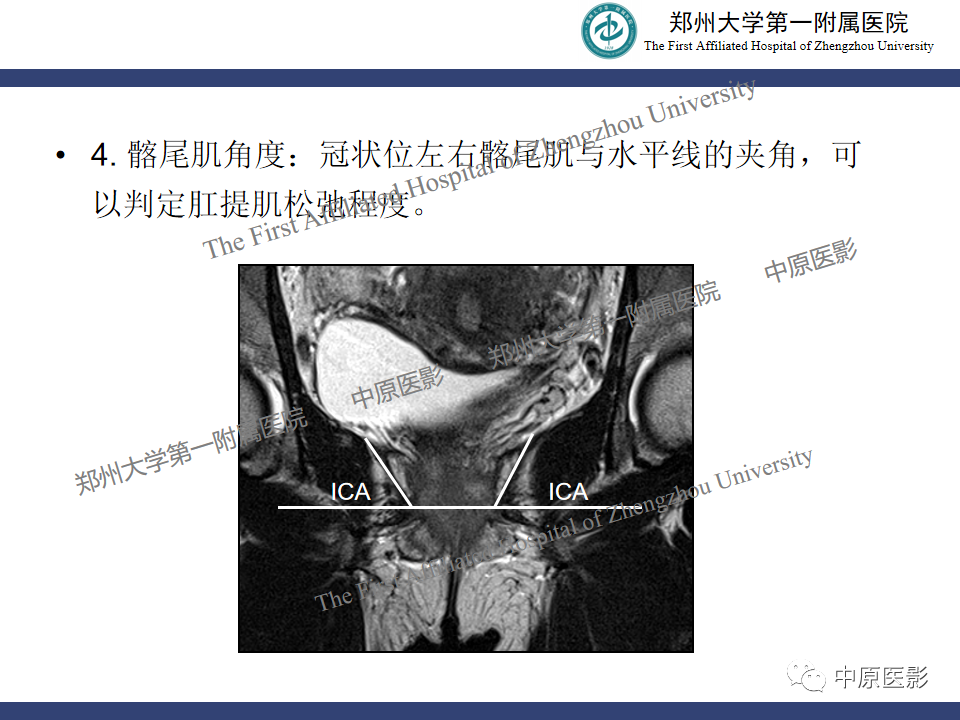 影像PPT - 【病例】盆底功能障碍性疾病2例MR影像-21