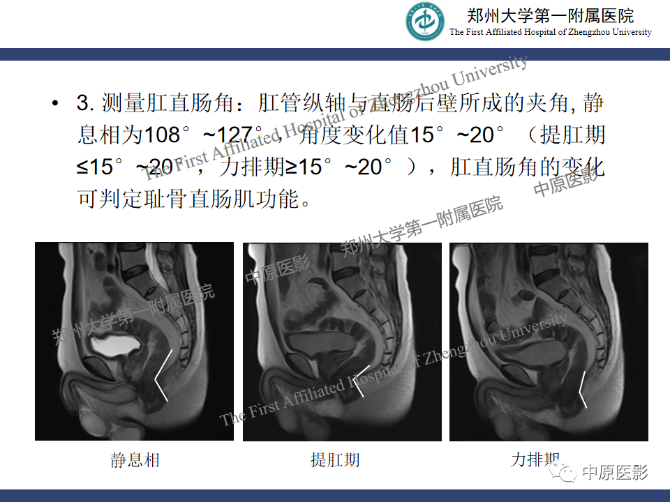 影像PPT - 【病例】盆底功能障碍性疾病2例MR影像-20