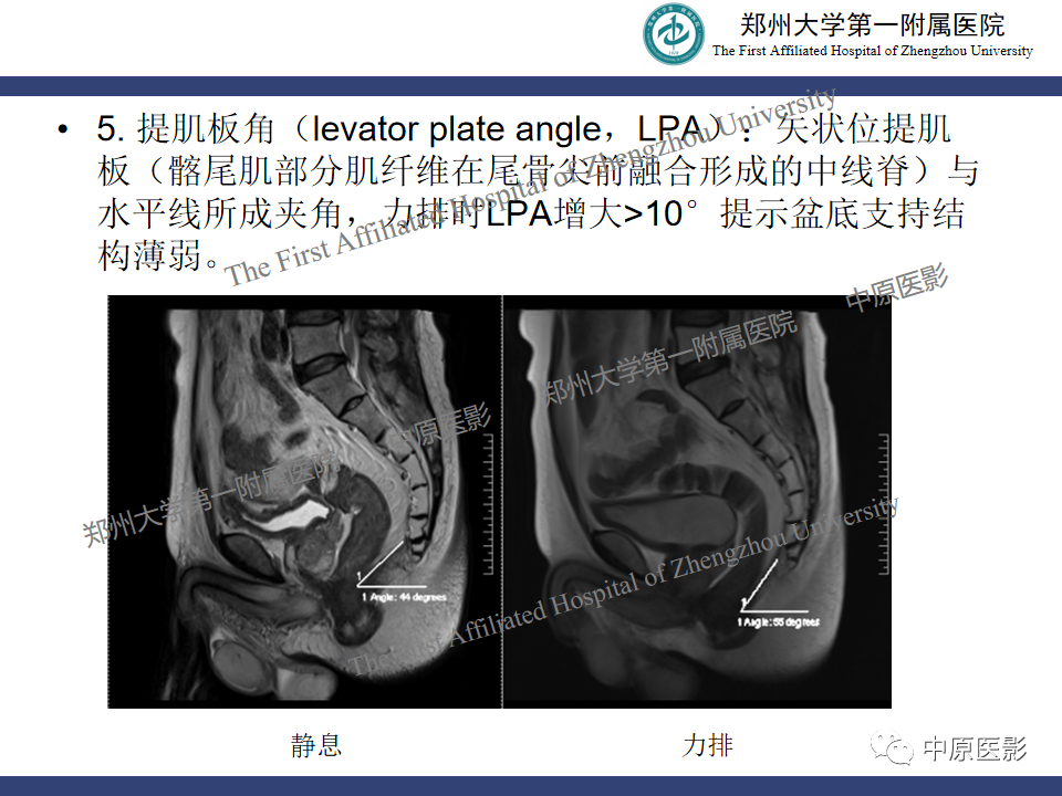 影像PPT - 【病例】盆底功能障碍性疾病2例MR影像-22