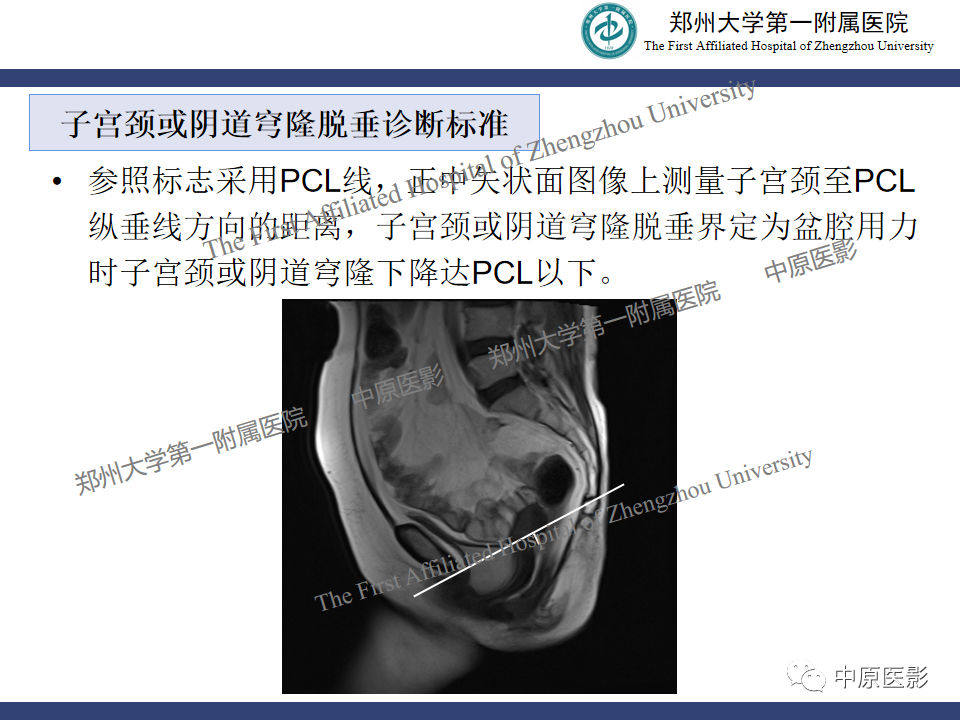 影像PPT - 【病例】盆底功能障碍性疾病2例MR影像-24
