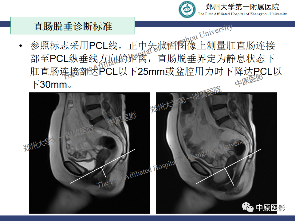 影像PPT - 【病例】盆底功能障碍性疾病2例MR影像-25