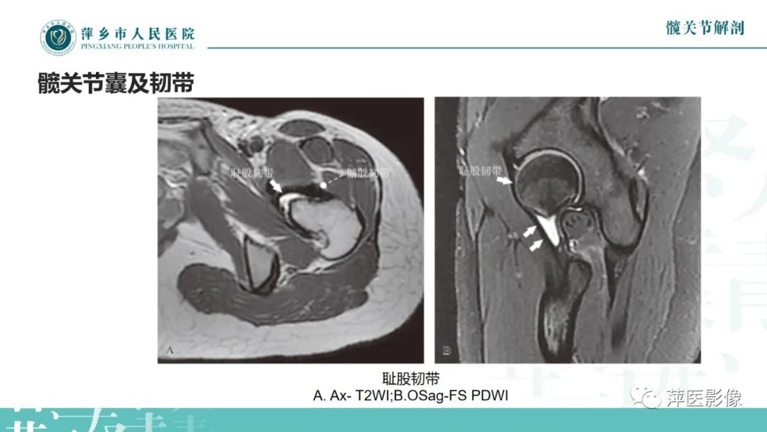 影像PPT - 【PPT】髋关节撞击综合征-12
