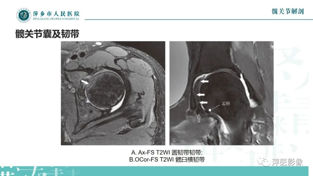 影像PPT - 【PPT】髋关节撞击综合征-15