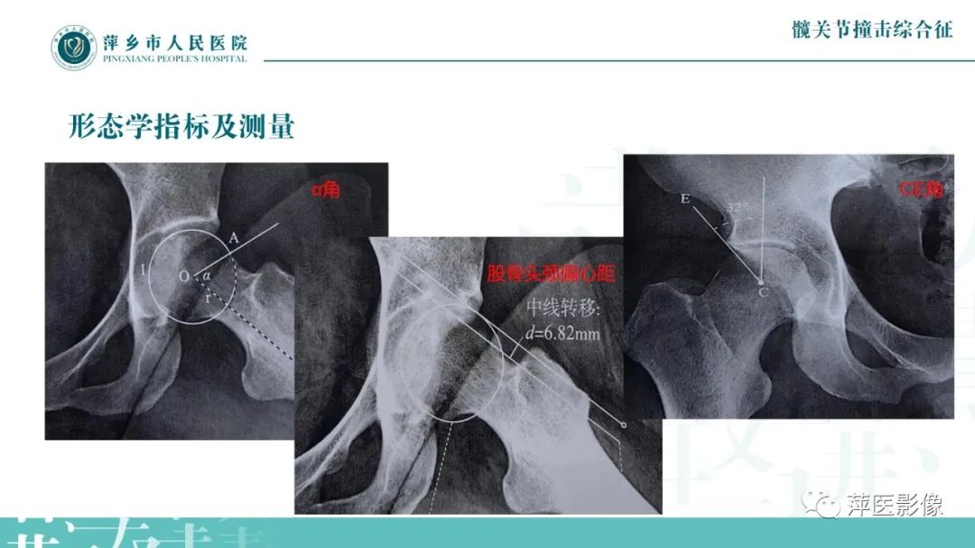 影像PPT - 【PPT】髋关节撞击综合征-21