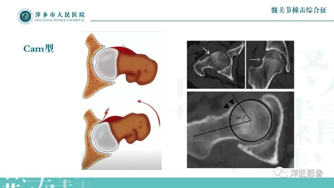 影像PPT - 【PPT】髋关节撞击综合征-24