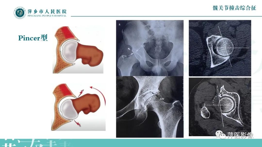 影像PPT - 【PPT】髋关节撞击综合征-26