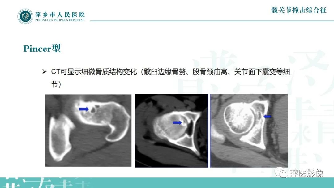 影像PPT - 【PPT】髋关节撞击综合征-27