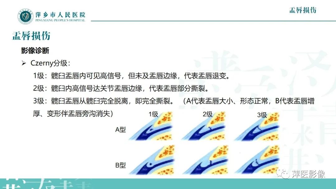 影像PPT - 【PPT】髋关节撞击综合征-31