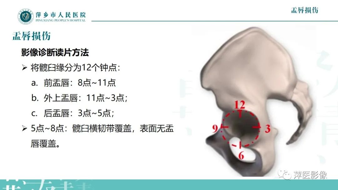 影像PPT - 【PPT】髋关节撞击综合征-32