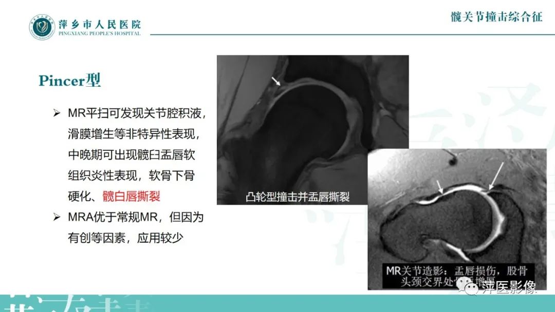 影像PPT - 【PPT】髋关节撞击综合征-28