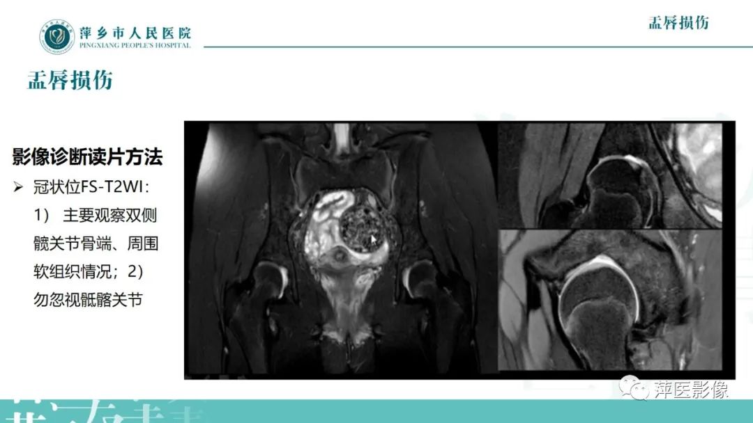 影像PPT - 【PPT】髋关节撞击综合征-33