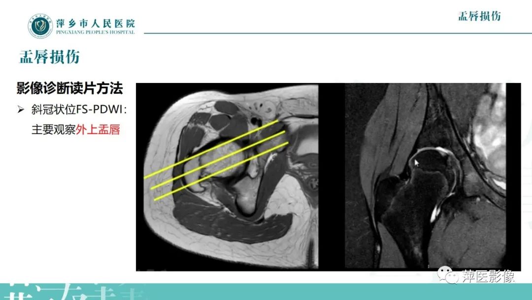 影像PPT - 【PPT】髋关节撞击综合征-34