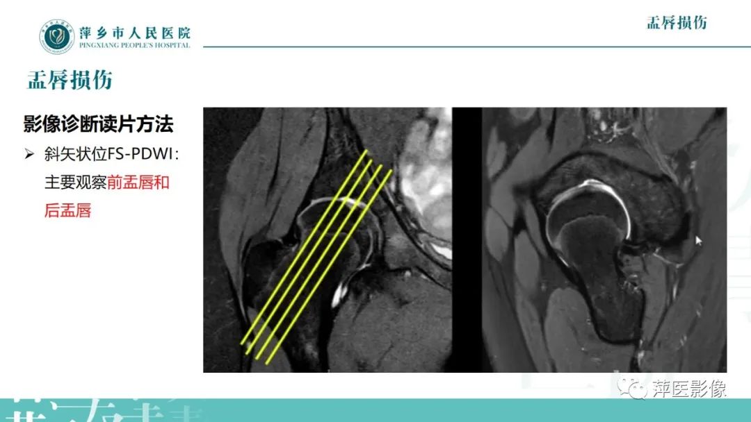 影像PPT - 【PPT】髋关节撞击综合征-35