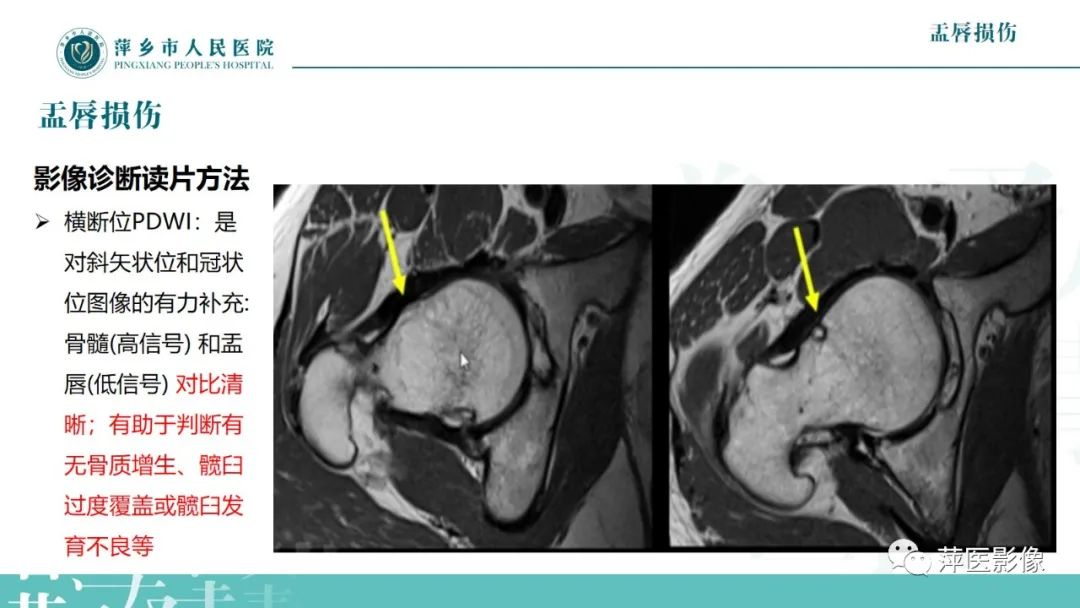 影像PPT - 【PPT】髋关节撞击综合征-36