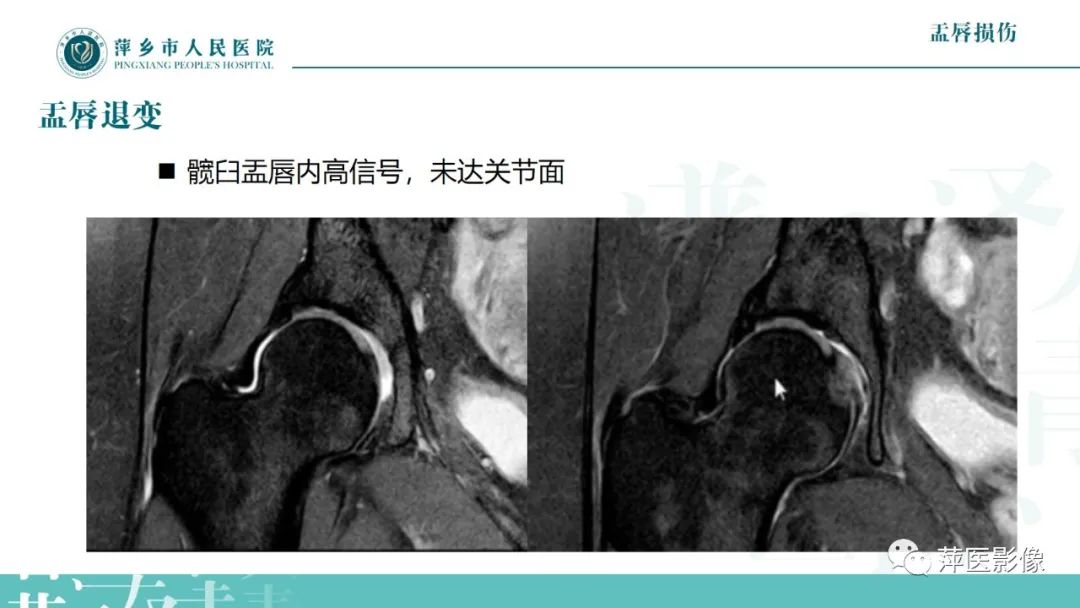 影像PPT - 【PPT】髋关节撞击综合征-38