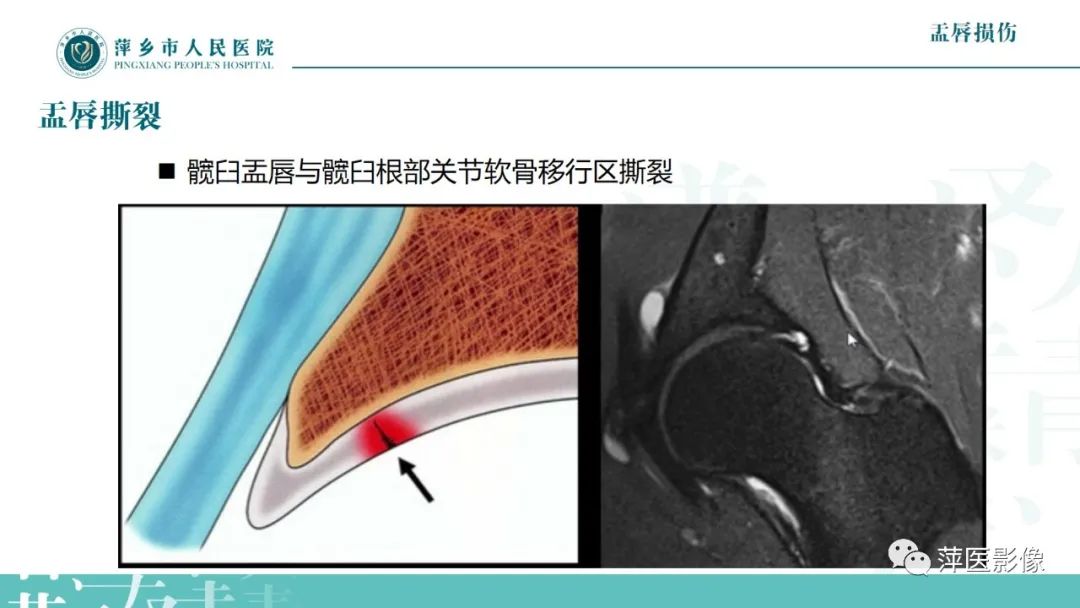 影像PPT - 【PPT】髋关节撞击综合征-39