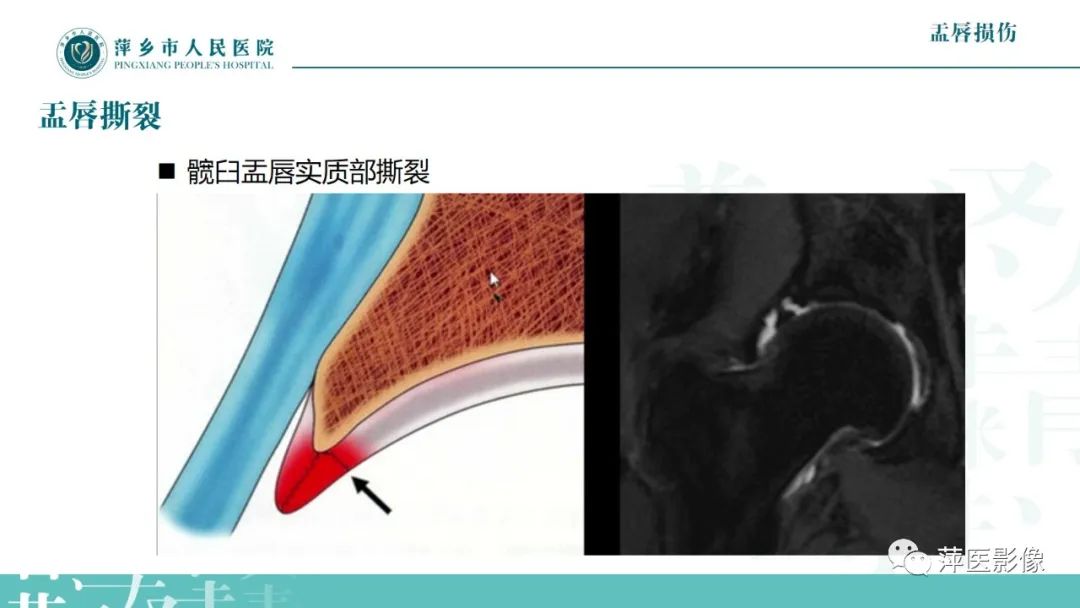 影像PPT - 【PPT】髋关节撞击综合征-40