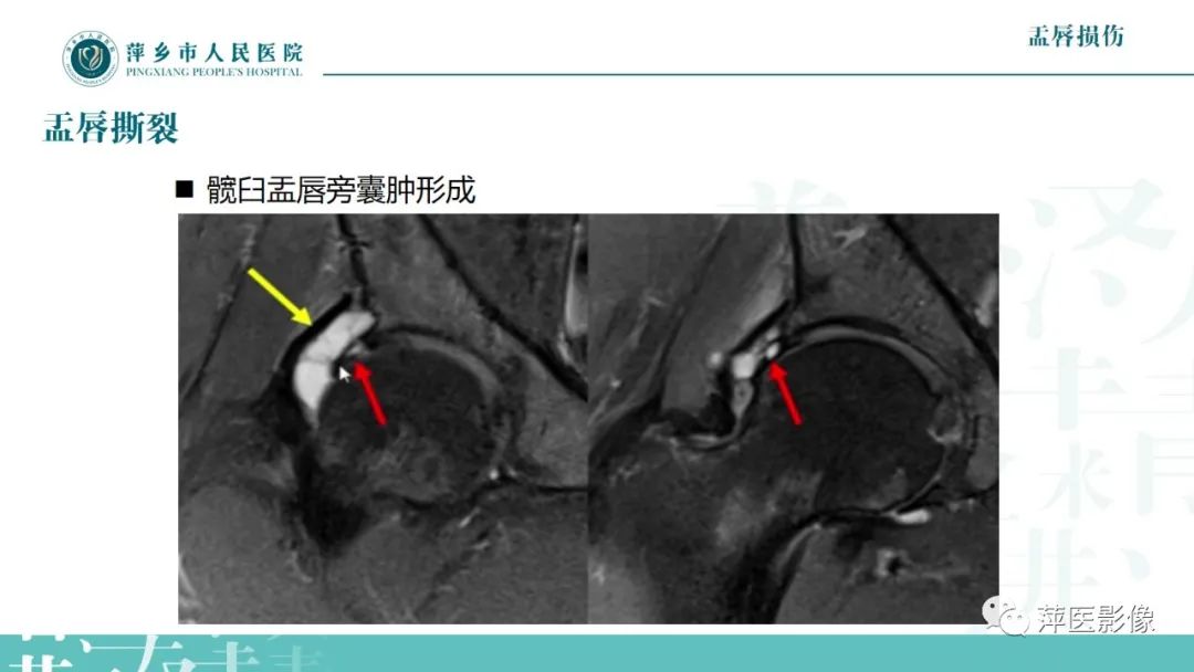 影像PPT - 【PPT】髋关节撞击综合征-41