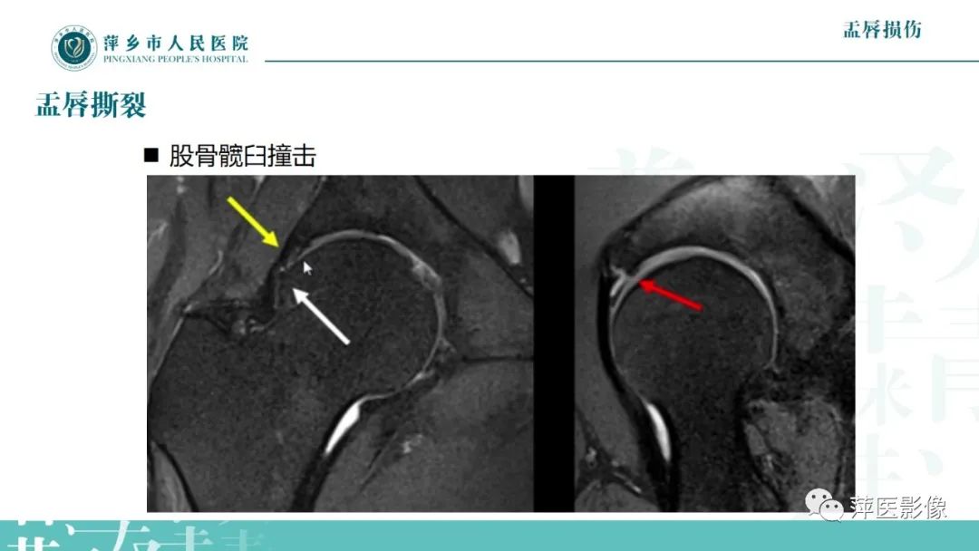 影像PPT - 【PPT】髋关节撞击综合征-42