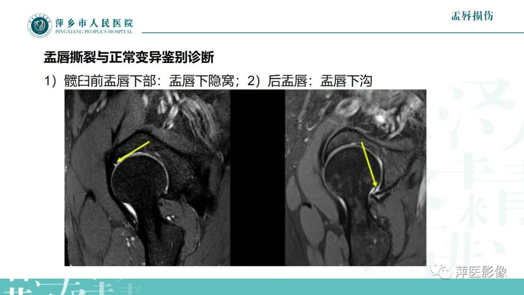 影像PPT - 【PPT】髋关节撞击综合征-43