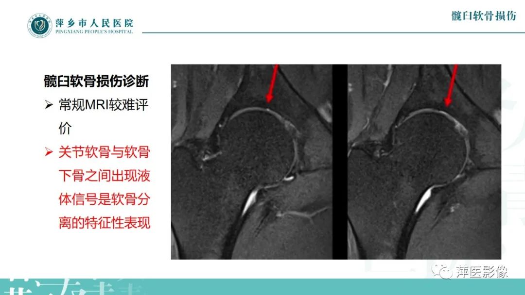 影像PPT - 【PPT】髋关节撞击综合征-45