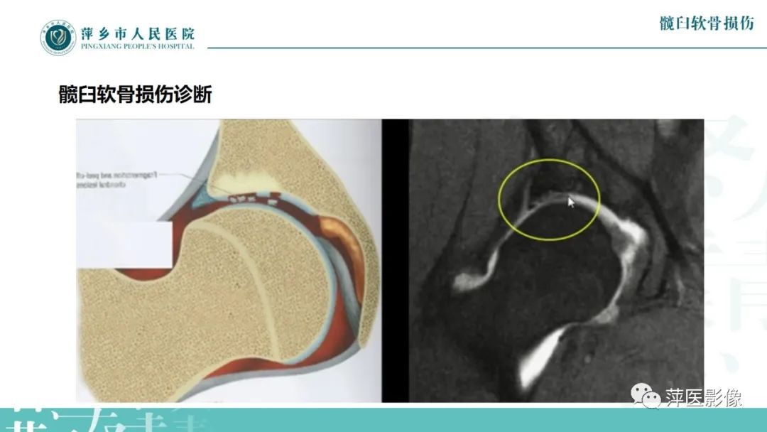 影像PPT - 【PPT】髋关节撞击综合征-46
