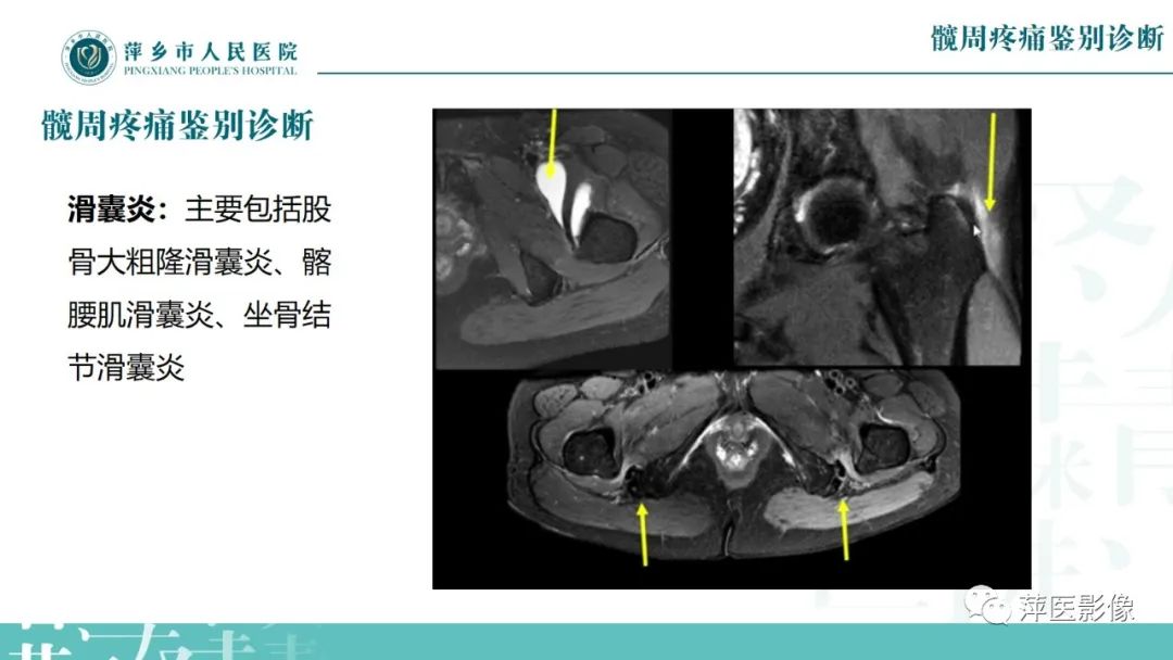 影像PPT - 【PPT】髋关节撞击综合征-48