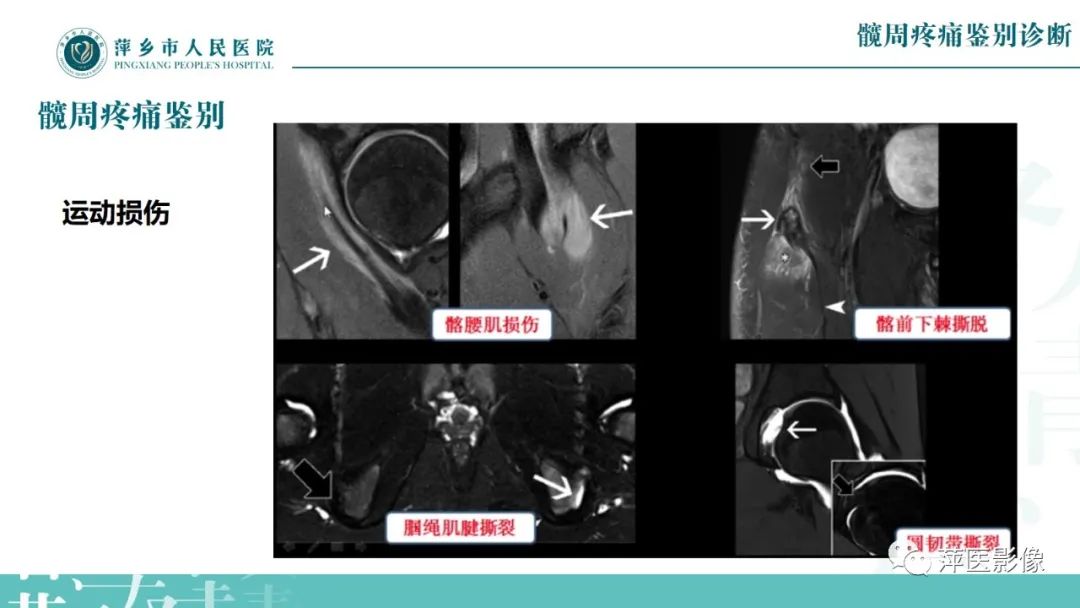 影像PPT - 【PPT】髋关节撞击综合征-49