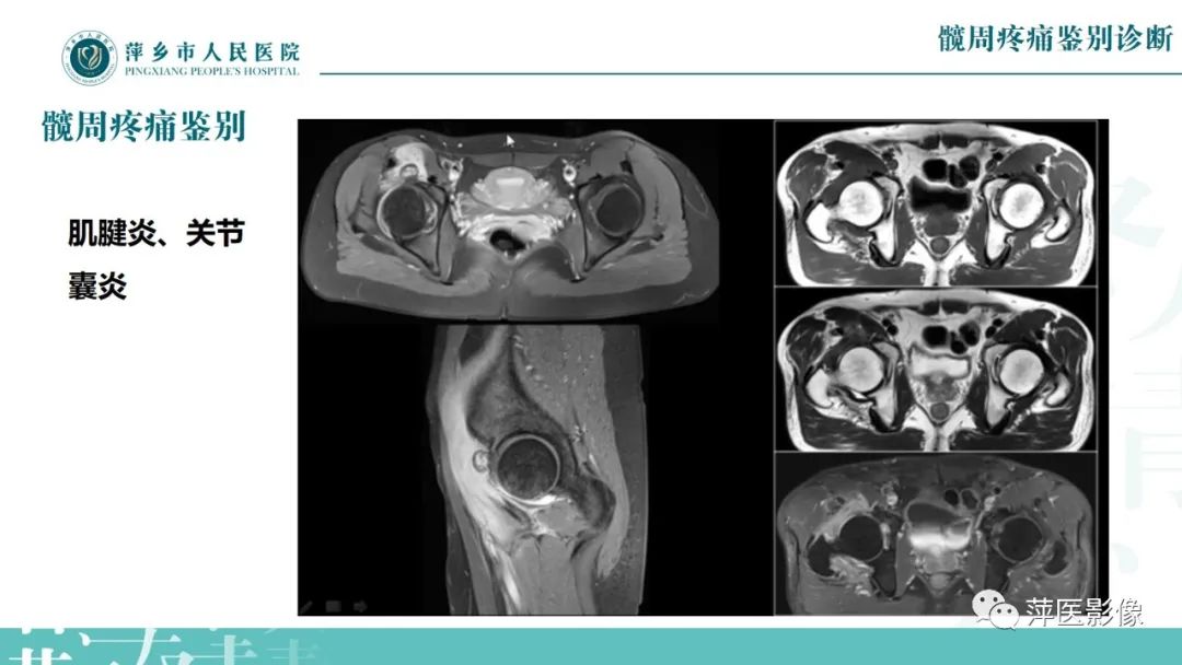 影像PPT - 【PPT】髋关节撞击综合征-50