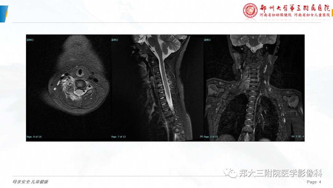 影像PPT - 【病例】颈椎骨样骨瘤1例CT及MR影像-4