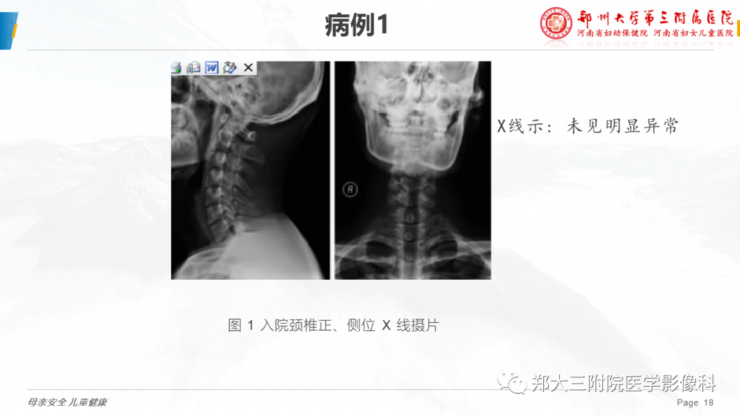 影像PPT - 【病例】颈椎骨样骨瘤1例CT及MR影像-18