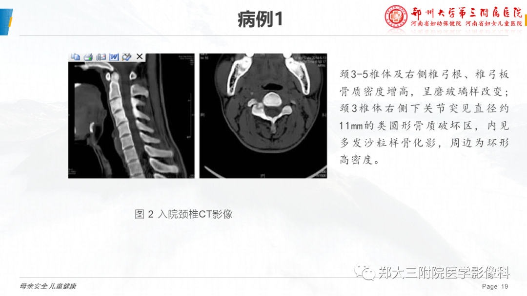 影像PPT - 【病例】颈椎骨样骨瘤1例CT及MR影像-19