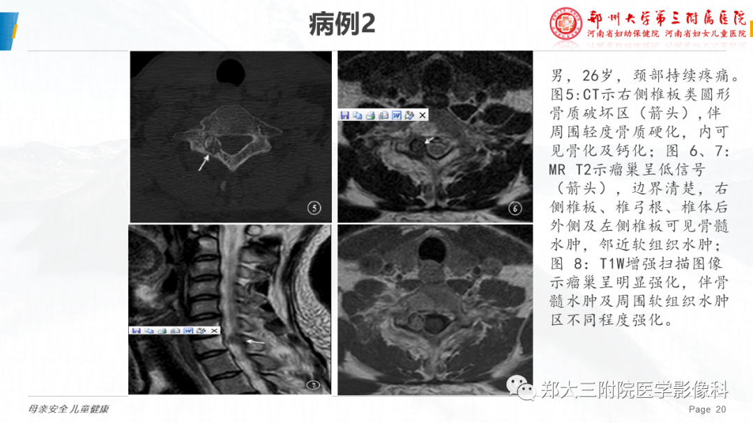 影像PPT - 【病例】颈椎骨样骨瘤1例CT及MR影像-20