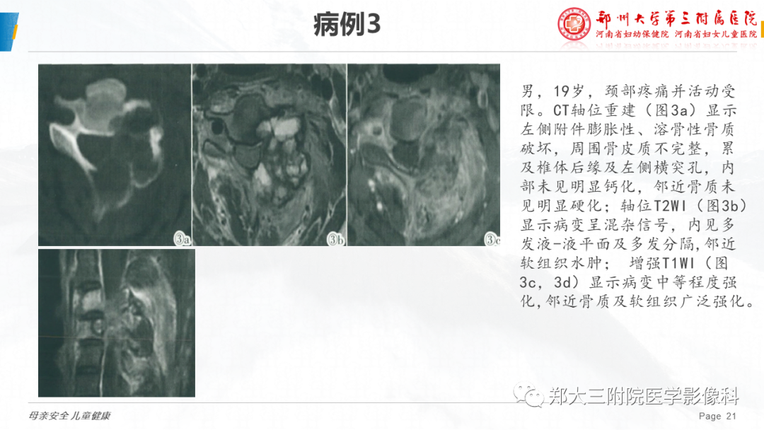影像PPT - 【病例】颈椎骨样骨瘤1例CT及MR影像-21