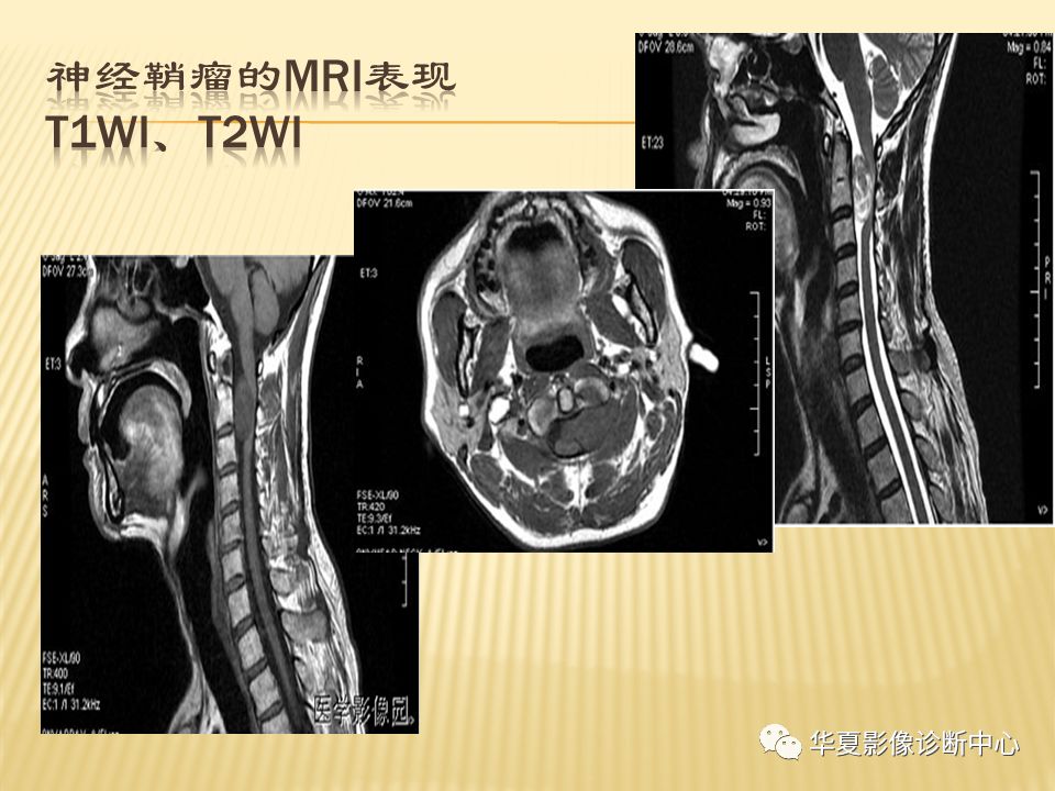影像PPT - “哑铃征”的椎管内肿瘤-7 影像PPT - “哑铃征”的椎管内肿瘤-7