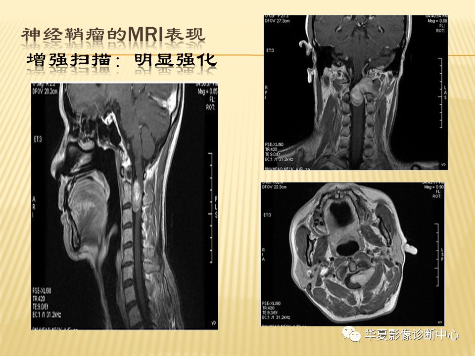 影像PPT - “哑铃征”的椎管内肿瘤-8 影像PPT - “哑铃征”的椎管内肿瘤-8
