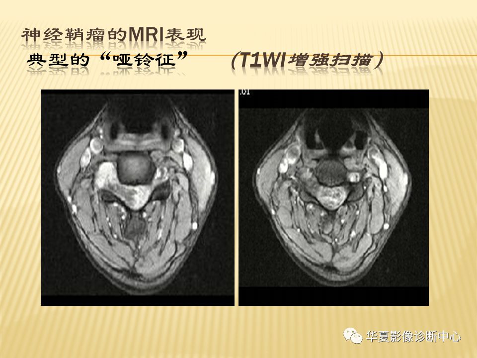 影像PPT - “哑铃征”的椎管内肿瘤-11 影像PPT - “哑铃征”的椎管内肿瘤-11