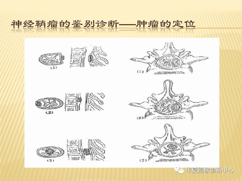 影像PPT - “哑铃征”的椎管内肿瘤-13 影像PPT - “哑铃征”的椎管内肿瘤-13
