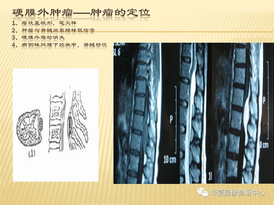 影像PPT - “哑铃征”的椎管内肿瘤-14 影像PPT - “哑铃征”的椎管内肿瘤-14