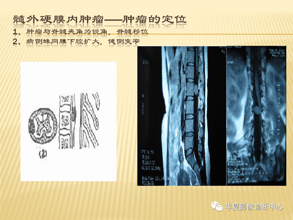 影像PPT - “哑铃征”的椎管内肿瘤-15 影像PPT - “哑铃征”的椎管内肿瘤-15