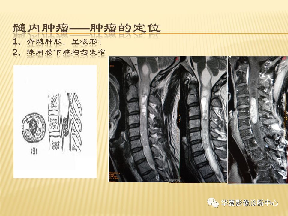 影像PPT - “哑铃征”的椎管内肿瘤-16 影像PPT - “哑铃征”的椎管内肿瘤-16