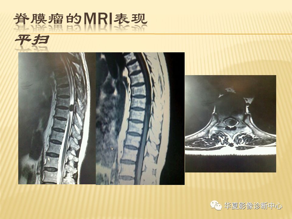 影像PPT - “哑铃征”的椎管内肿瘤-18 影像PPT - “哑铃征”的椎管内肿瘤-18