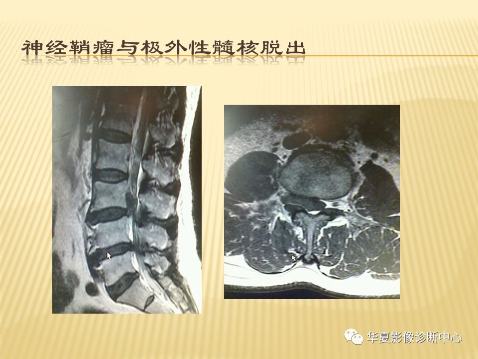 影像PPT - “哑铃征”的椎管内肿瘤-22 影像PPT - “哑铃征”的椎管内肿瘤-22