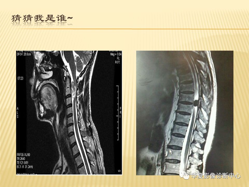 影像PPT - “哑铃征”的椎管内肿瘤-21 影像PPT - “哑铃征”的椎管内肿瘤-21