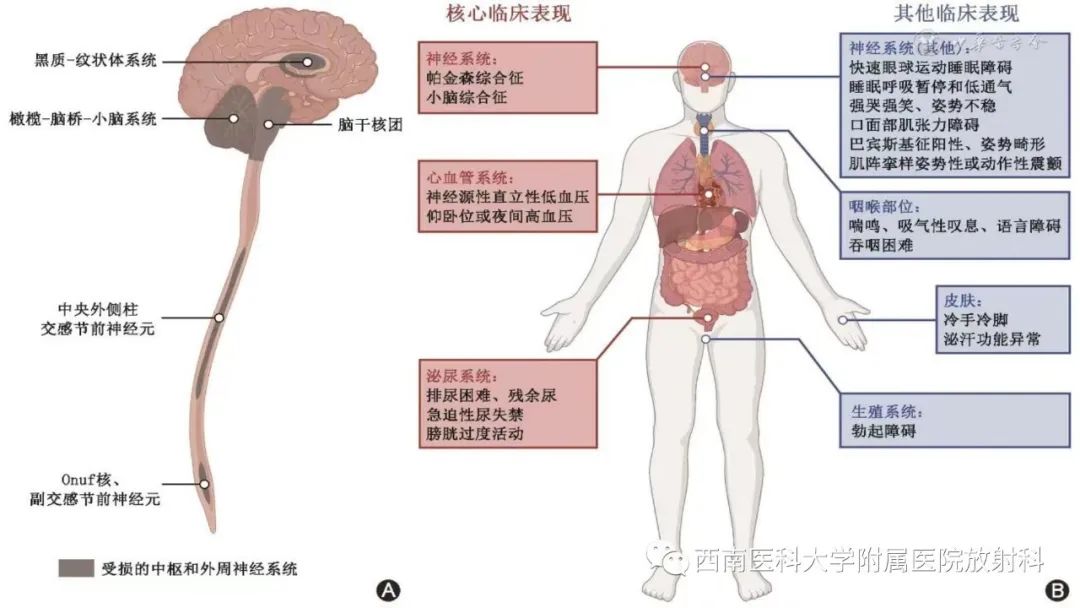 影像PPT - 【PPT】多系统萎缩-5