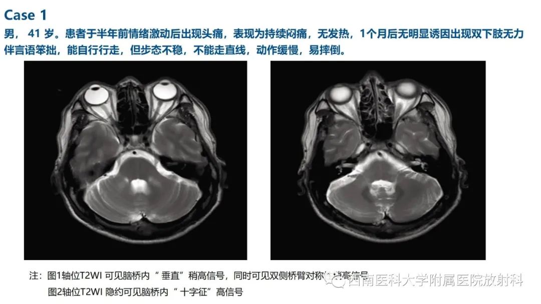 影像PPT - 【PPT】多系统萎缩-11